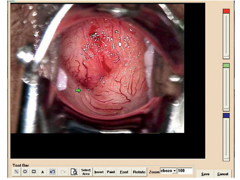 Kolposkopijas programmatūra un uztveršanas karte video kolposkopam COLPRO LED. Medicīnas ierīce   Klase:  I